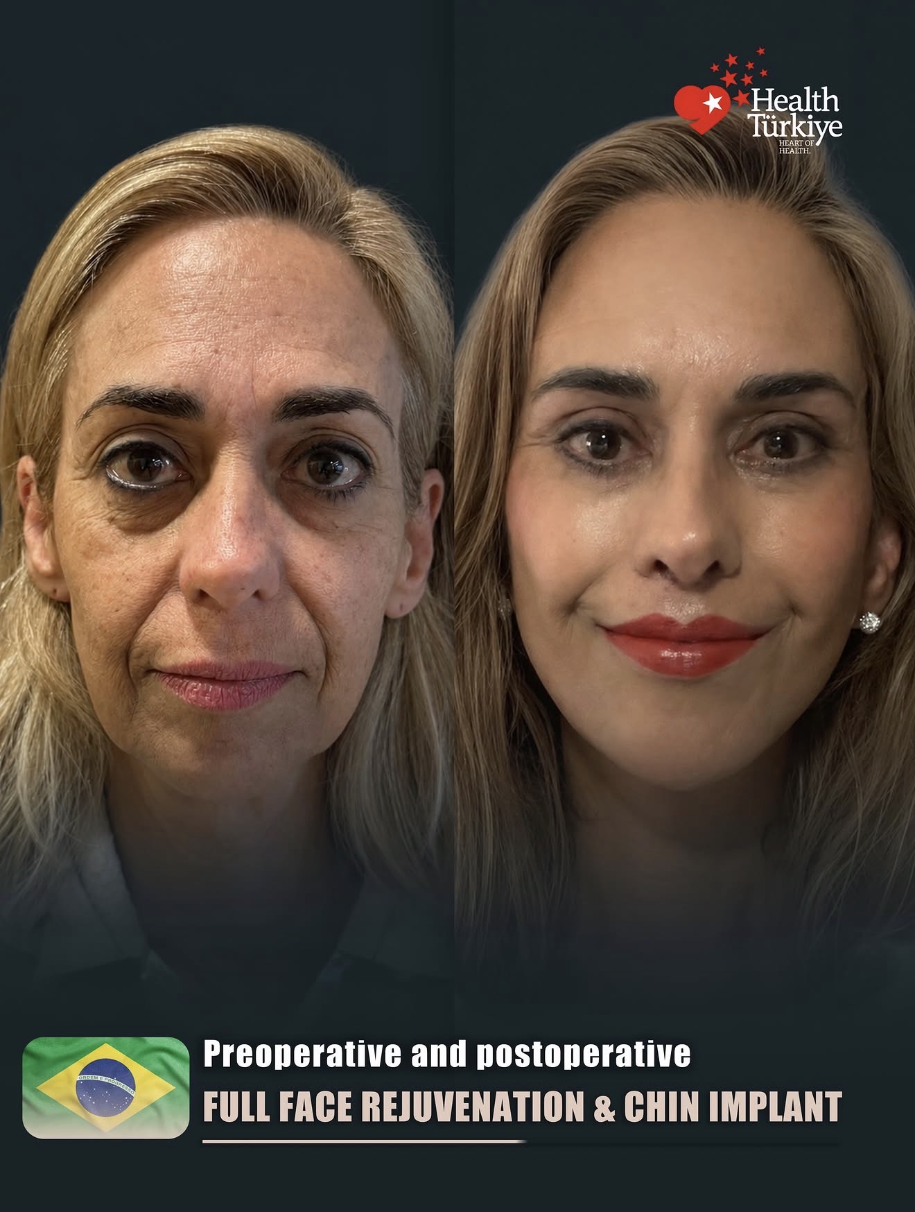 Face Lift – Hasta 1