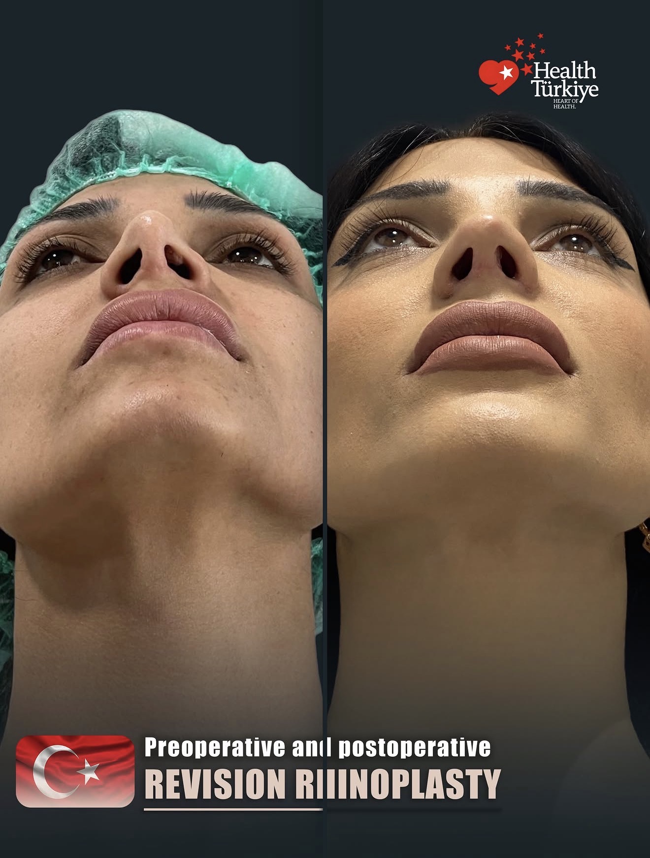 Revision Rhinoplasty – HASTA 1