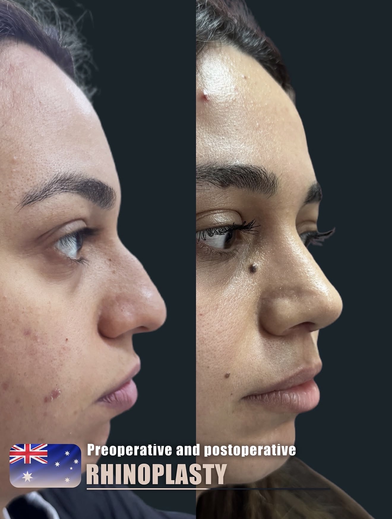 Revision Rhinoplasty – HASTA 2