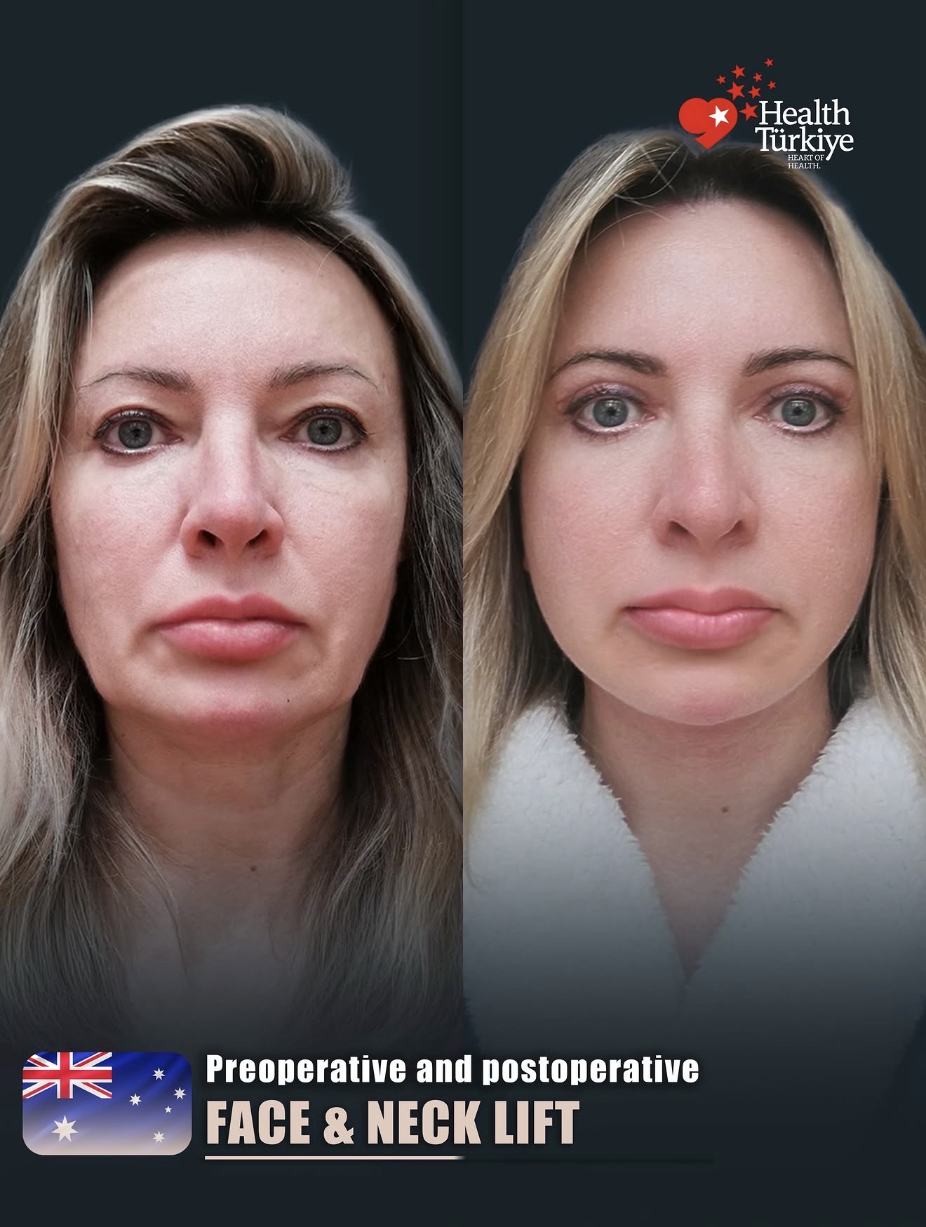 Neck Lift – HASTA 2