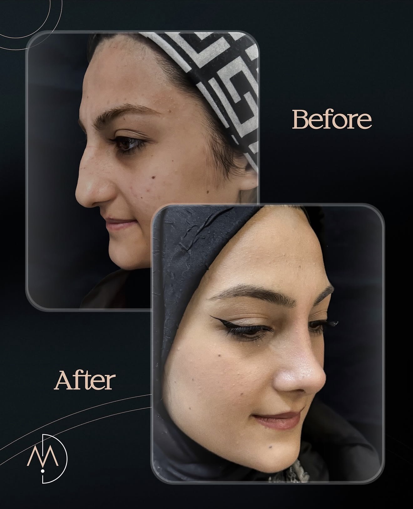 Rhinoplasty – HASTA 6