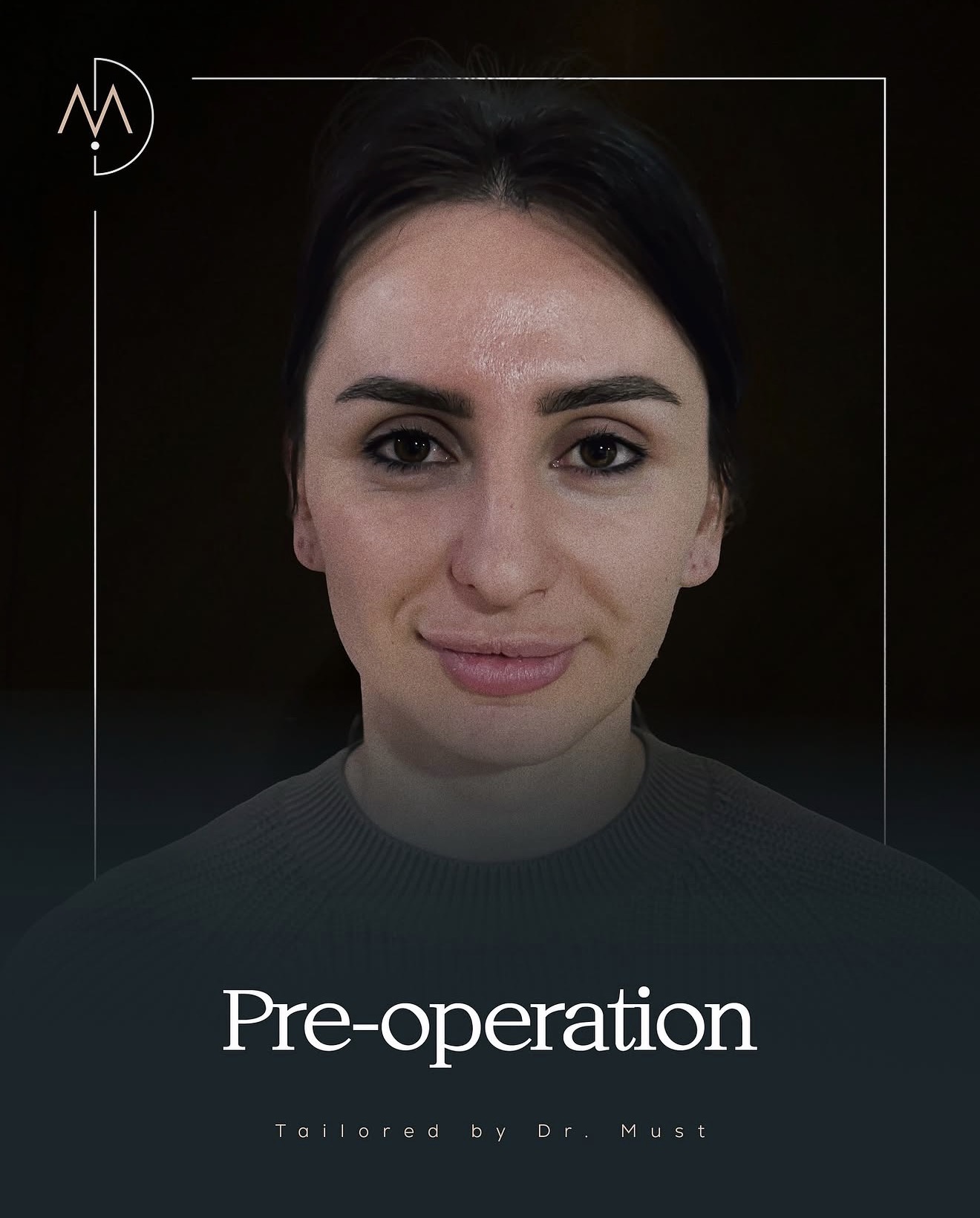 Rhinoplasty – HASTA 7