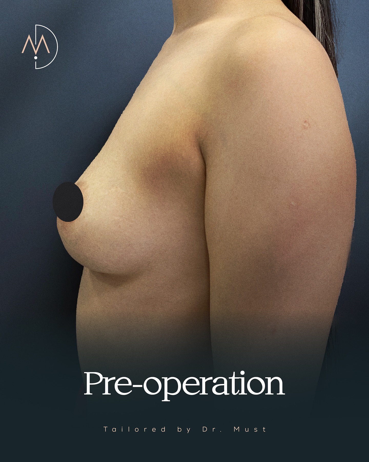 Breast Implant – HASTA 1