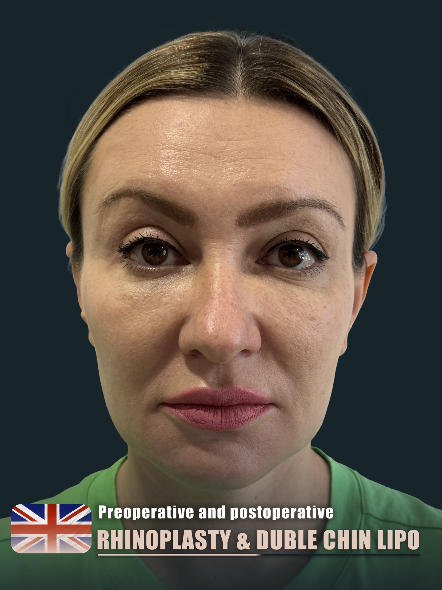 Rhinoplasty – HASTA 3