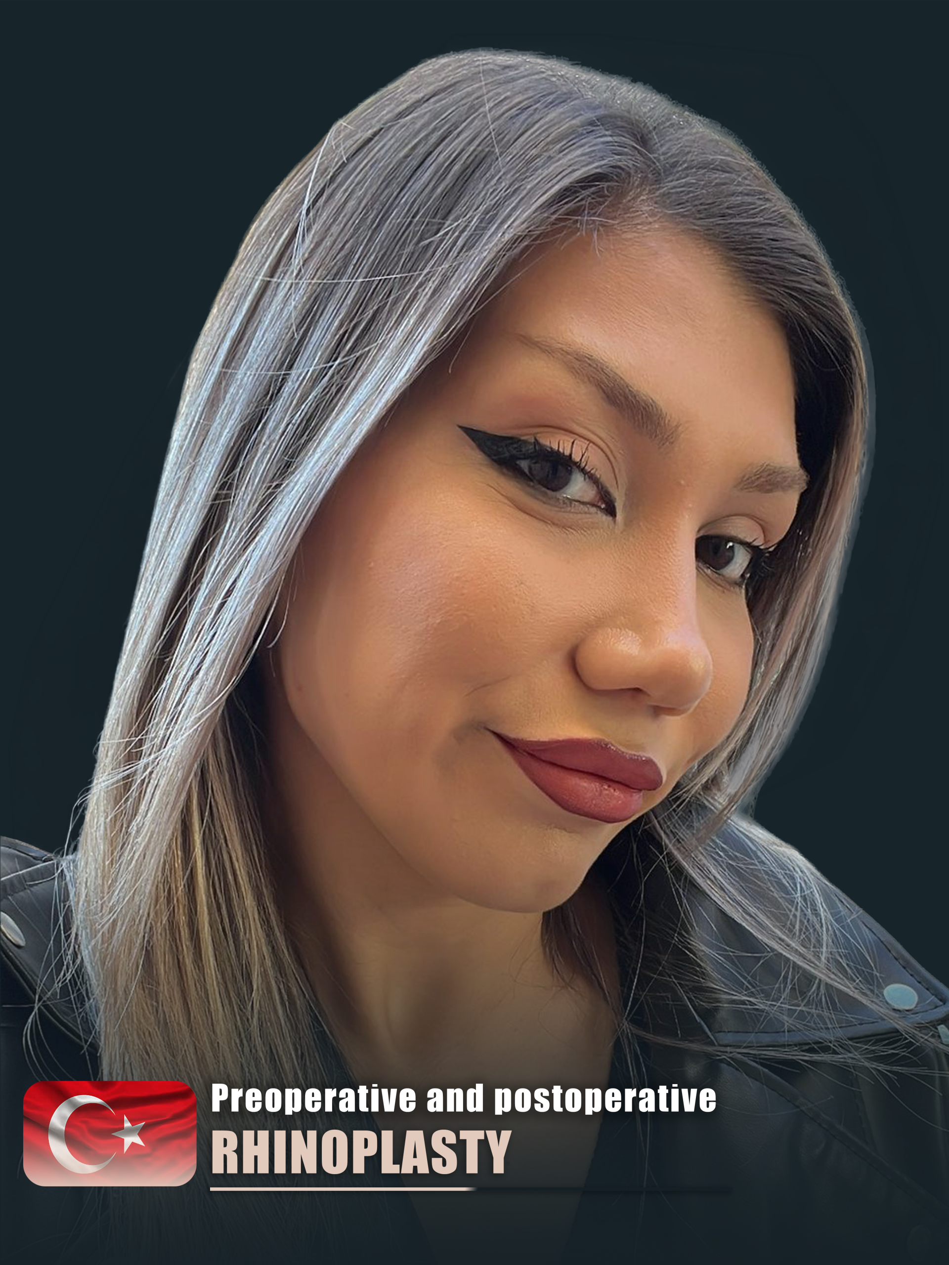 Rhinoplasty – HASTA 1