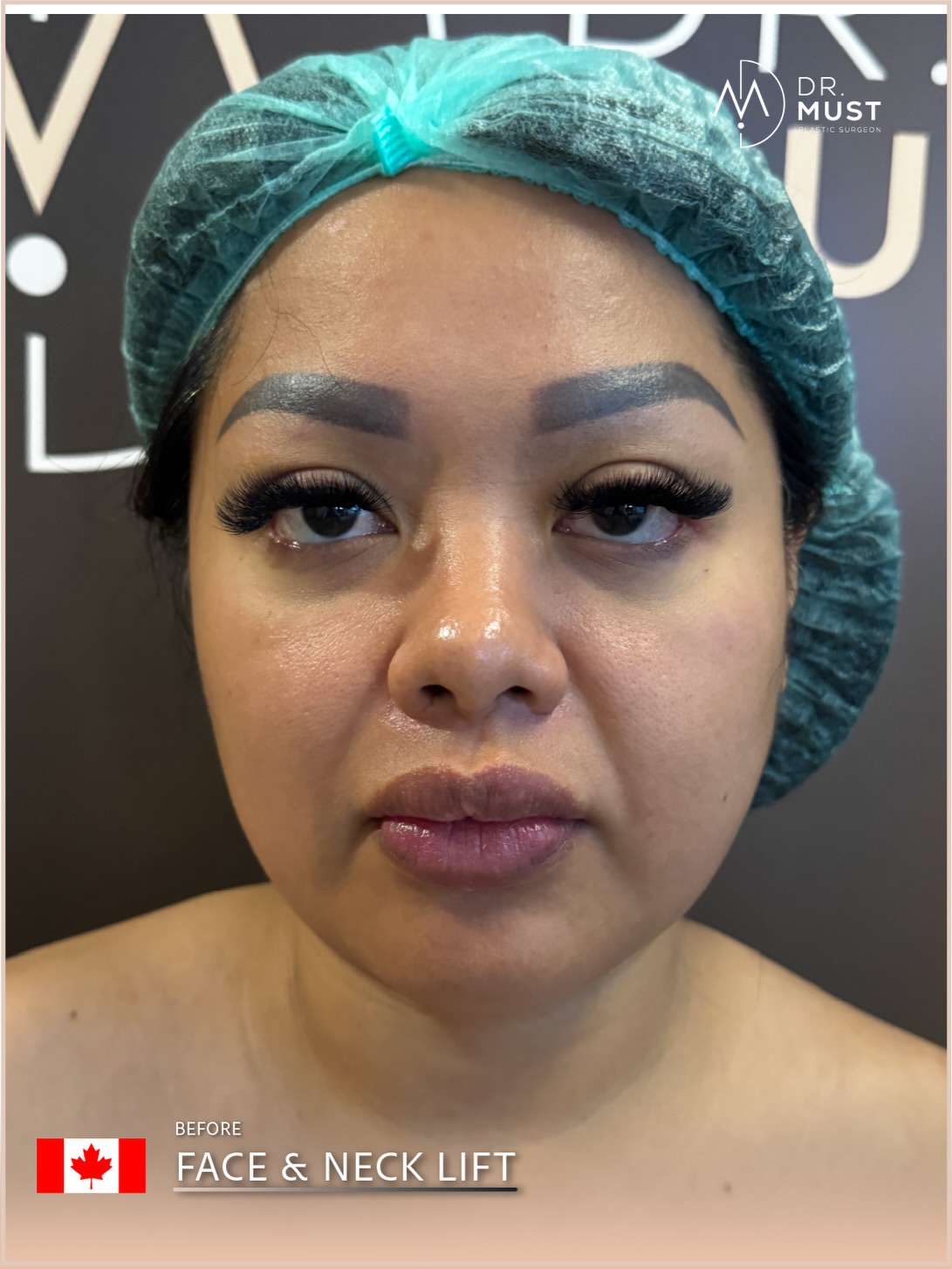 Neck Lift – HASTA 1