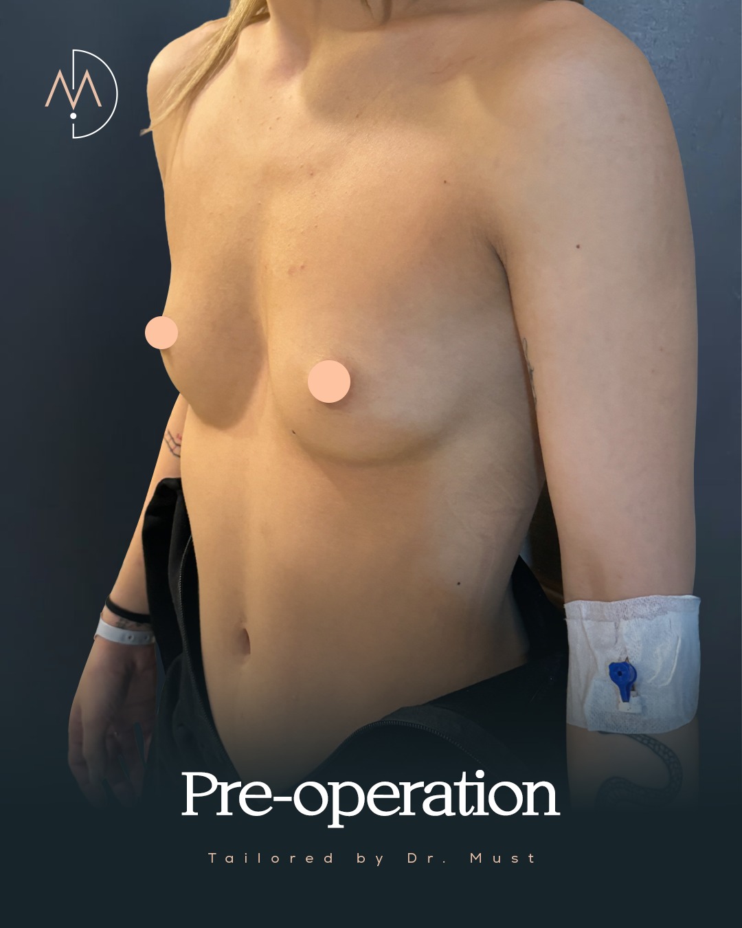 Breast Implant – HASTA 3 (abc1)