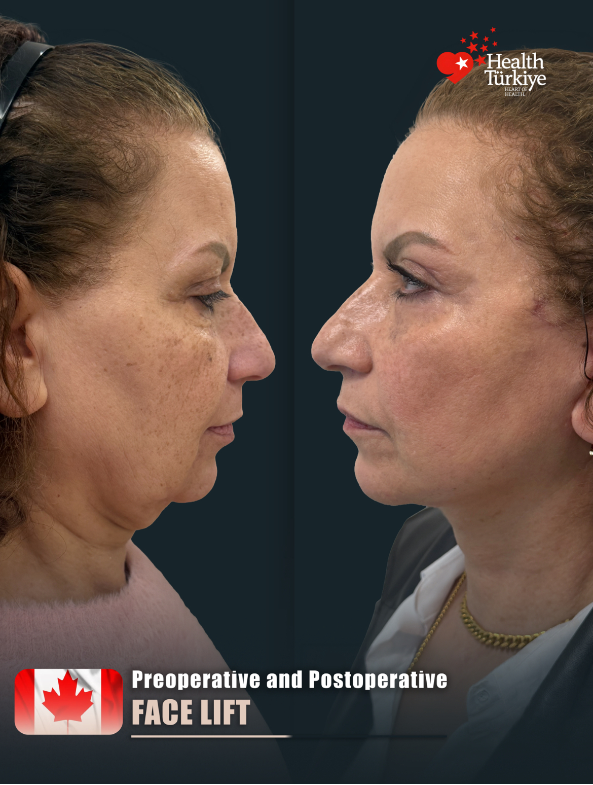 Face Lift – HASTA 1 (abc1)