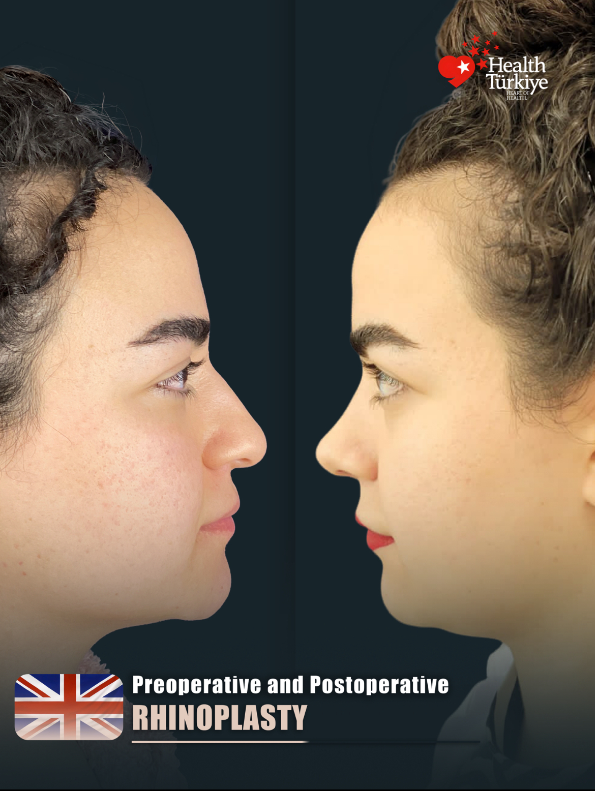 Rhinoplasty – HASTA 3 (abc1)