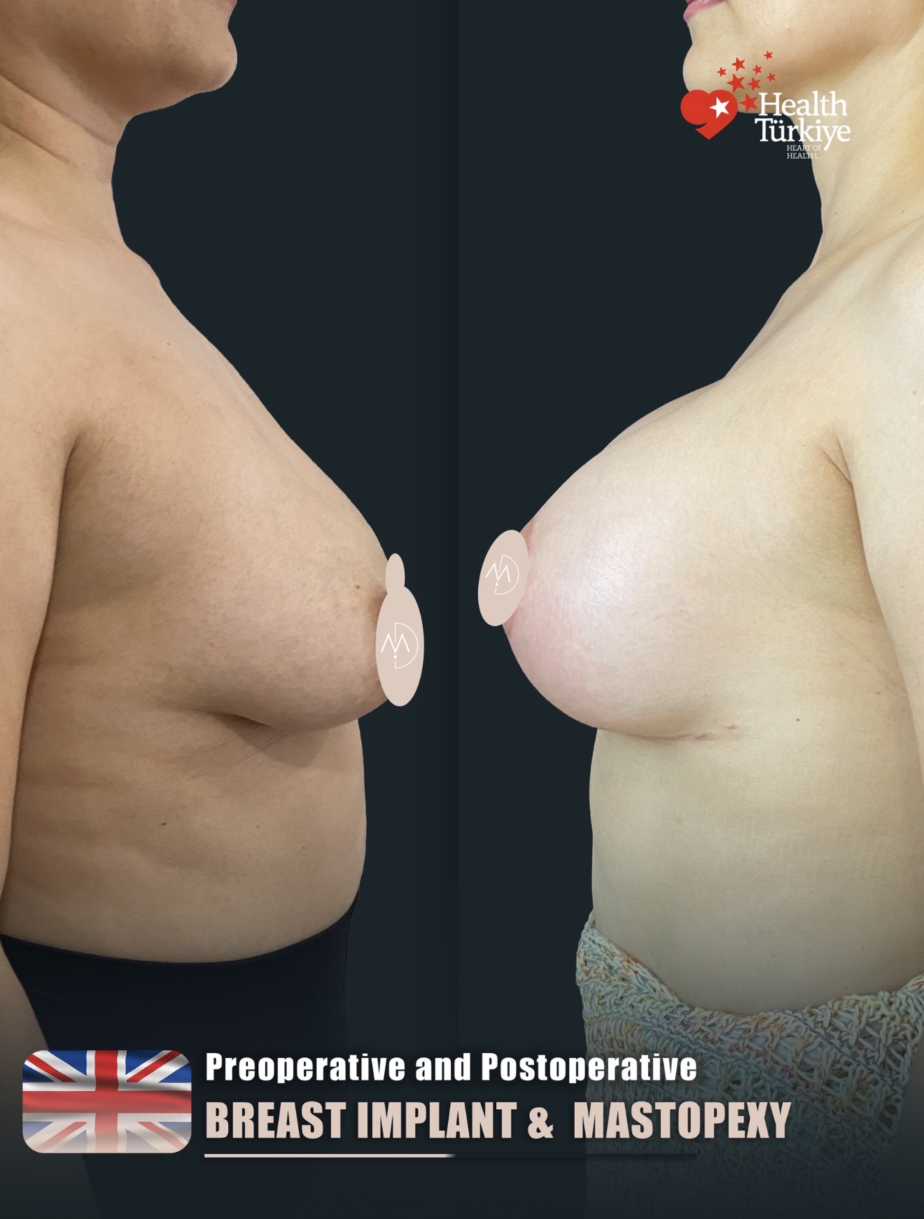 Breast Implant – HASTA 5 (abc1)