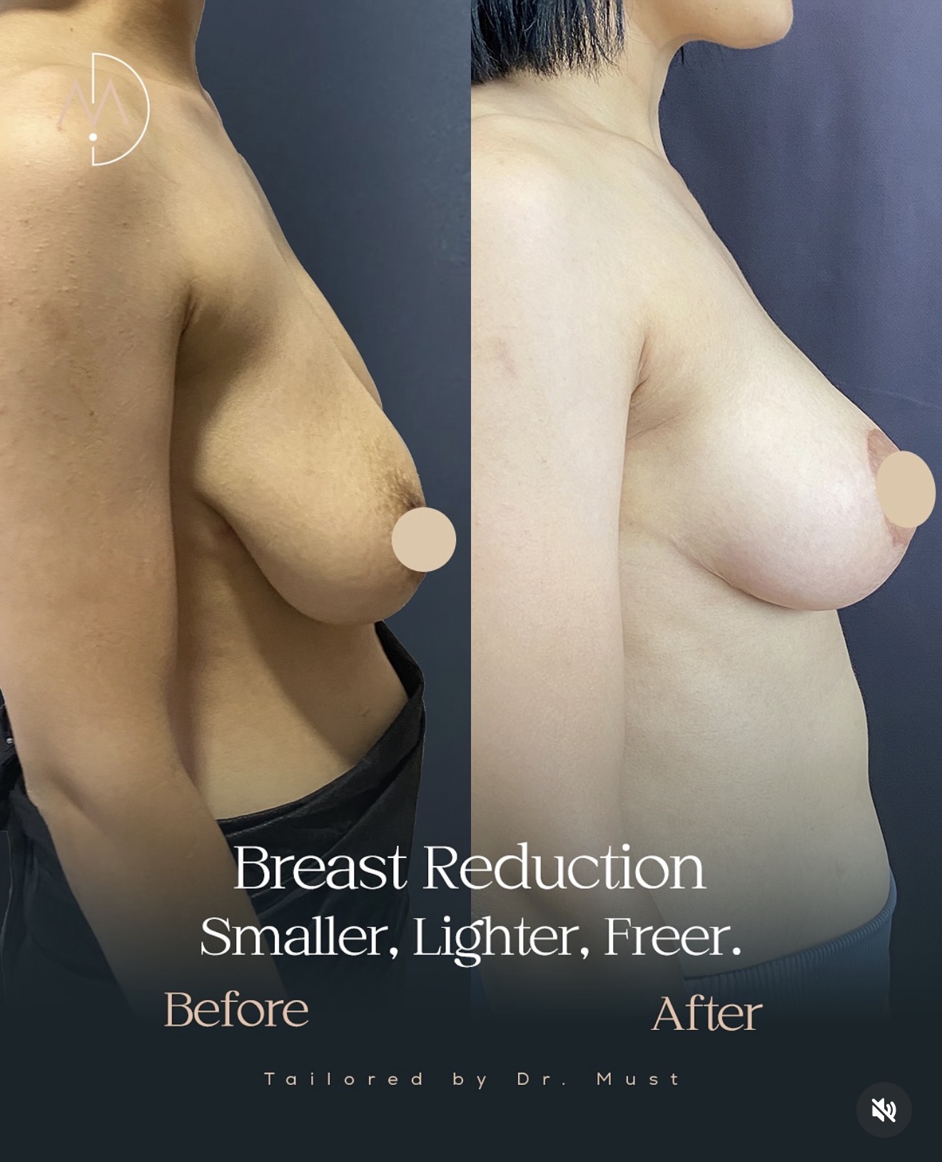 Breast Implant – HASTA 6 (abc1)