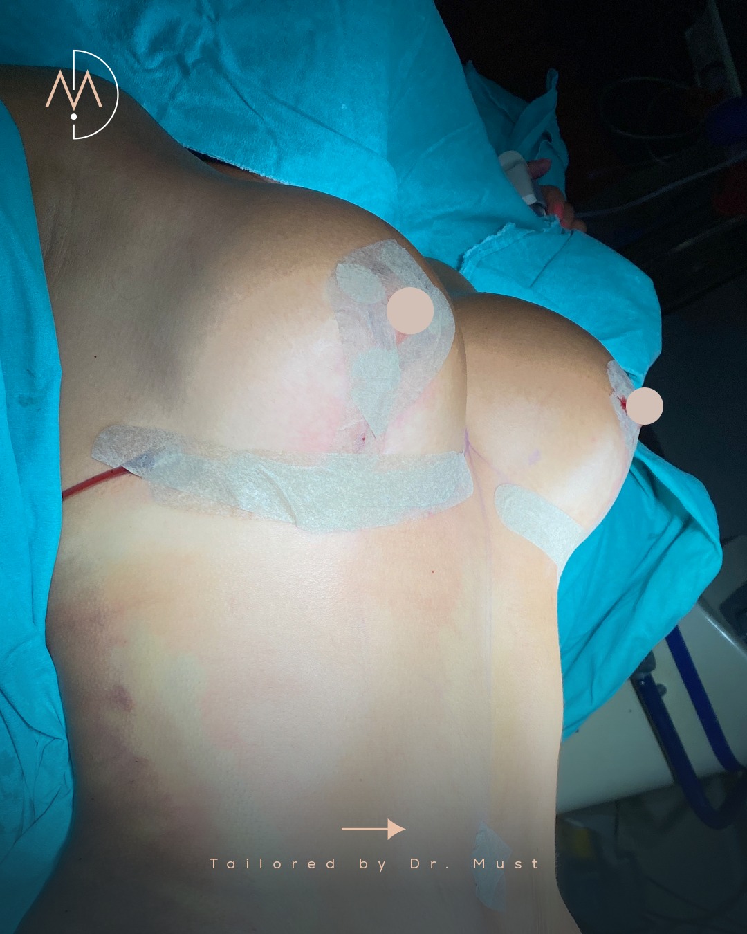Breast Implant – HASTA 2 (abc1)