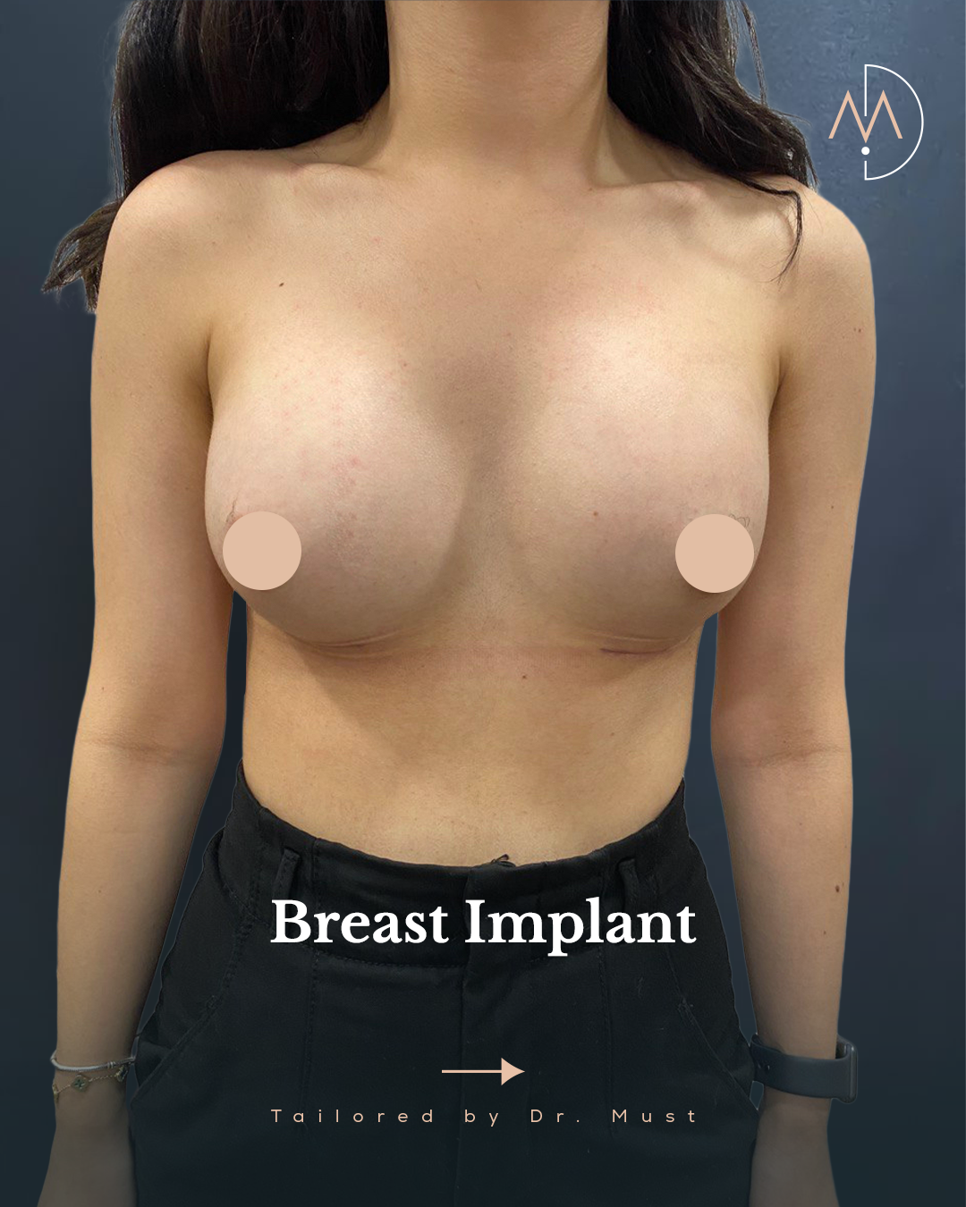 Breast Implant – HHASTA 4 (abc1)