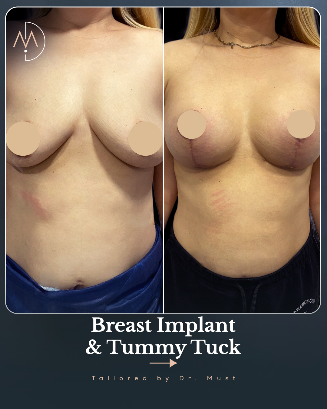 Tummy Tuck – HASTA 2 (abc1)