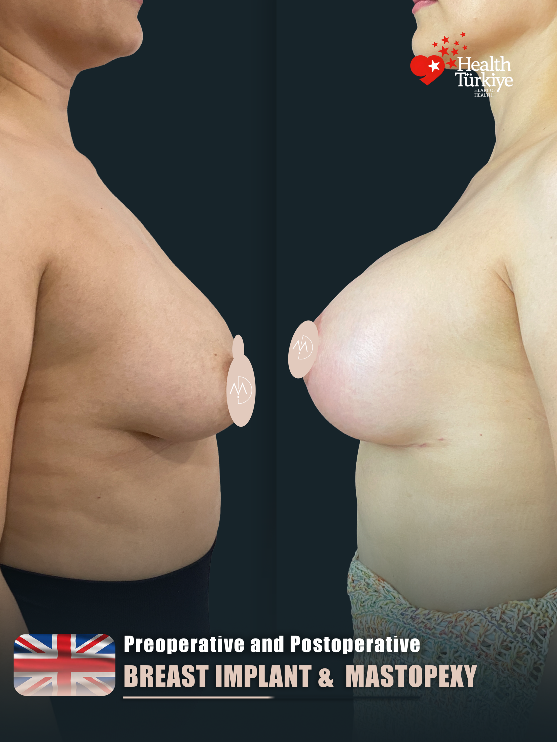 Mastopexy Implant – HASTA1 (abc1)