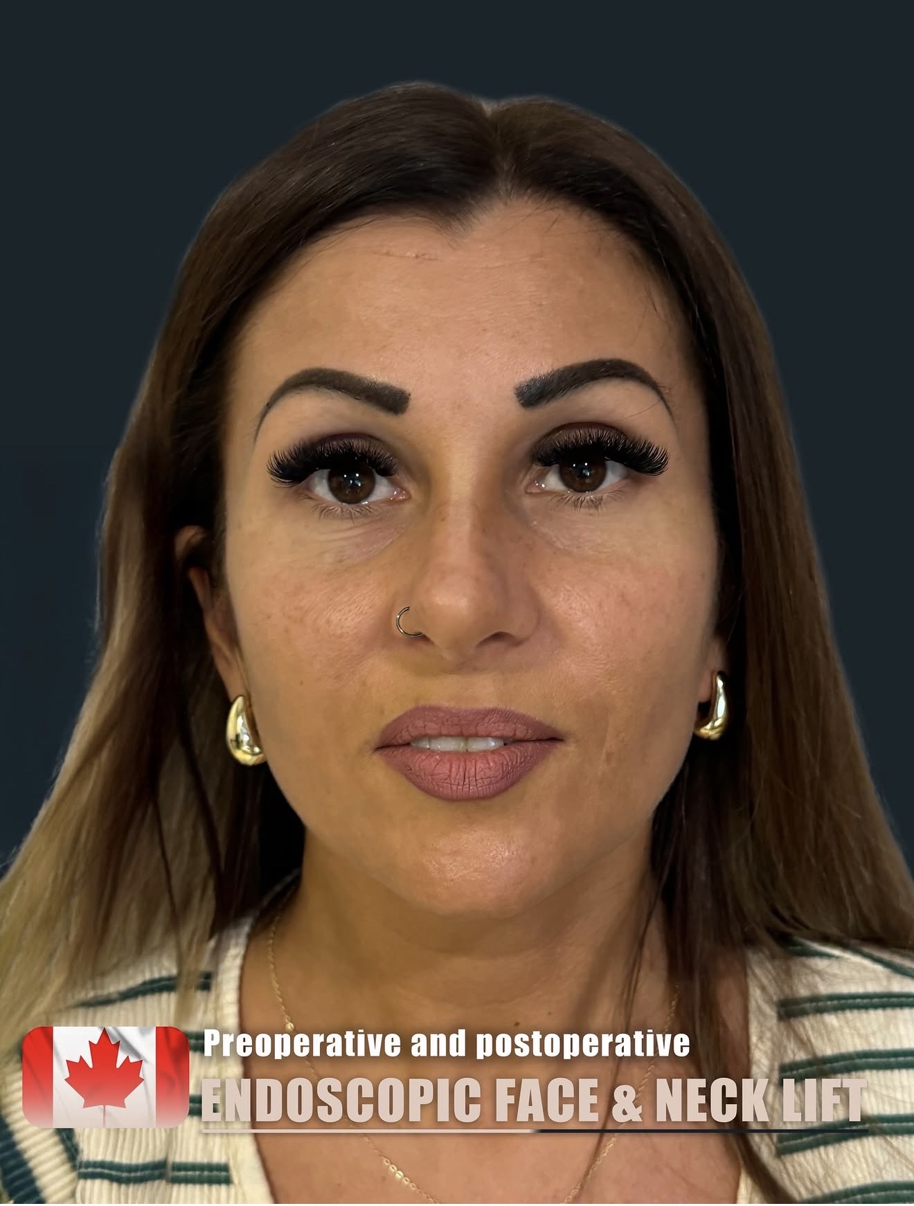 Endoscopic Face Lift – HASTA 1