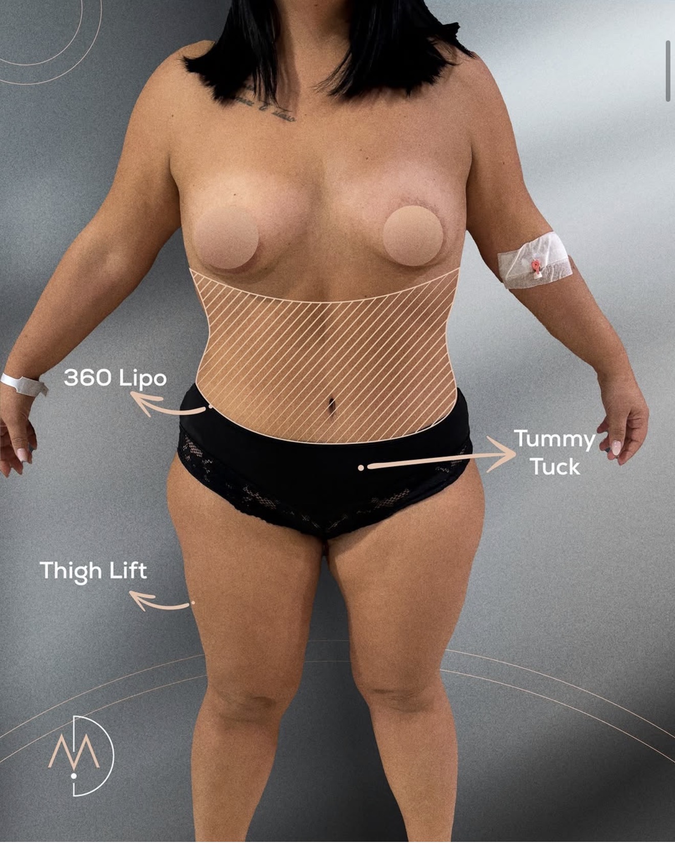 360 Lipo – HASTA 5