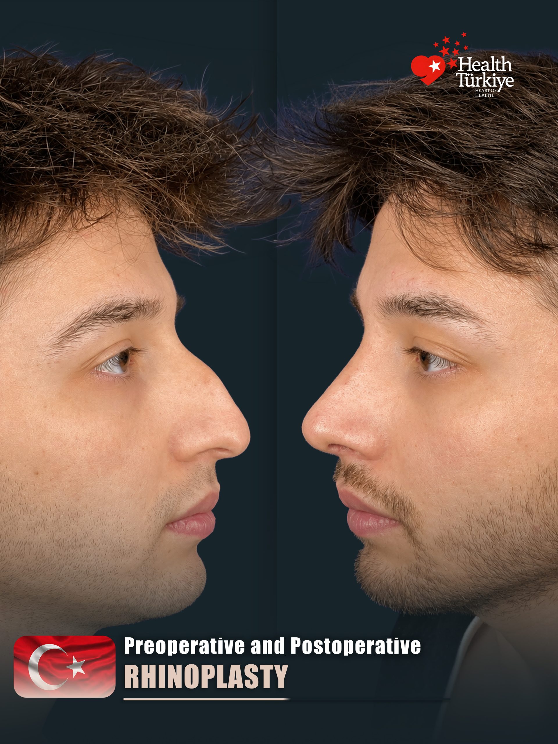 Rhinoplasty – HASTA 6 (m12)
